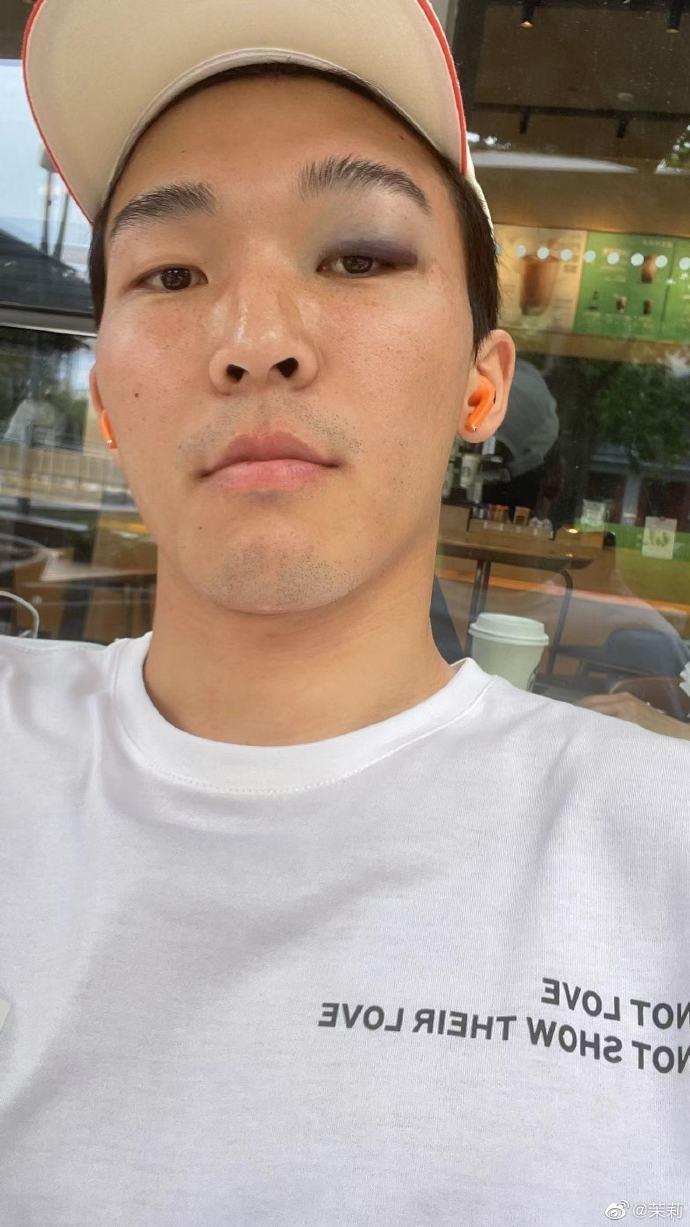 肿成熊猫眼了记者：元敏诚被撞到眼角，不得不休息两天