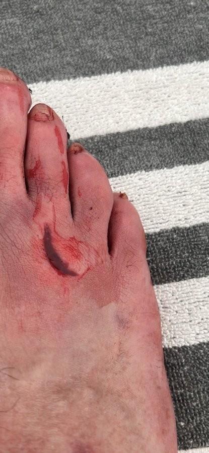 记者晒本泽马被巴列卡诺后卫踩踏后脚背伤口，缝了5针