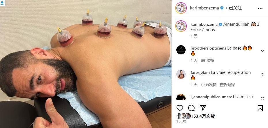 来自东方的秘术？本泽马社媒又双叒叕晒自己拔火罐照片