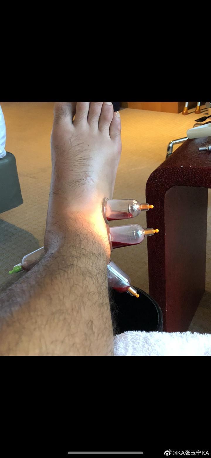 张玉宁晒照：右脚踝韧带扭伤 碎骨，目前积极康复中
