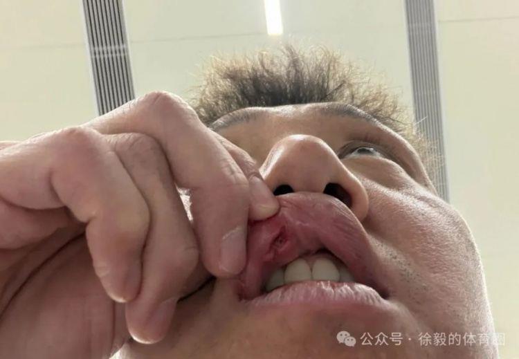 高迪赛后共缝九针：昨天蛮疼今天又是一条好汉，不想错过踢申花