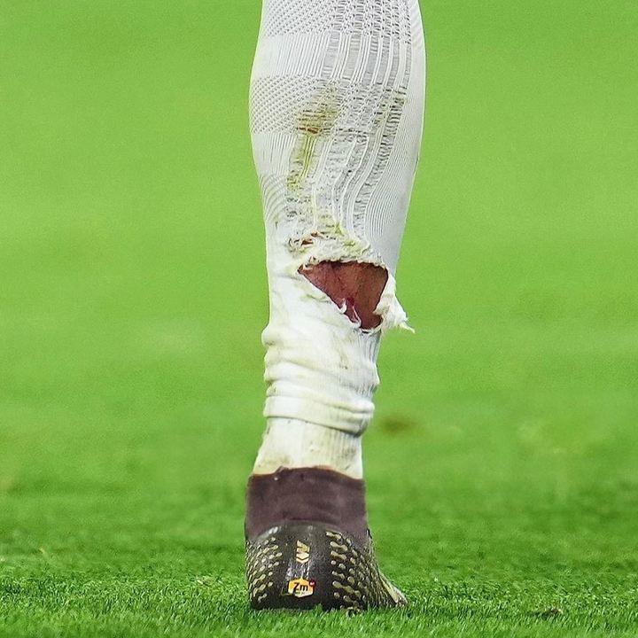 有点狠！塔蹬踏姆巴佩小腿染黄，姆巴佩小腿袜被踩破露出血痕