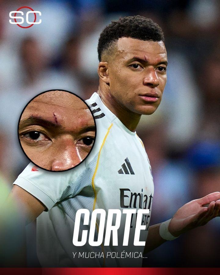 血洒球场！ESPN晒姆巴佩伤口图，伤痕明显有些肿