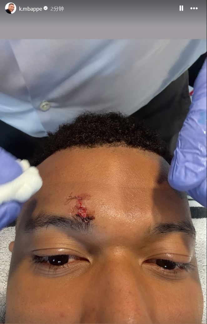 给姆总整破相了！姆巴佩晒脸部受伤近距离特写，眉骨缝了3针